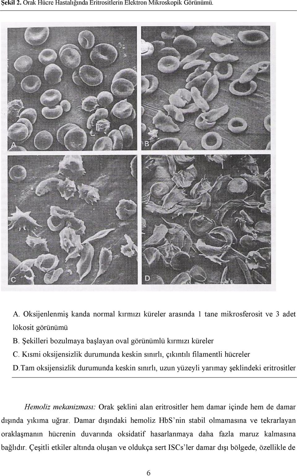 Tam oksijensizlik durumunda keskin sınırlı, uzun yüzeyli yarımay şeklindeki eritrositler Hemoliz mekanizması: Orak şeklini alan eritrositler hem damar içinde hem de damar dışında yıkıma uğrar.
