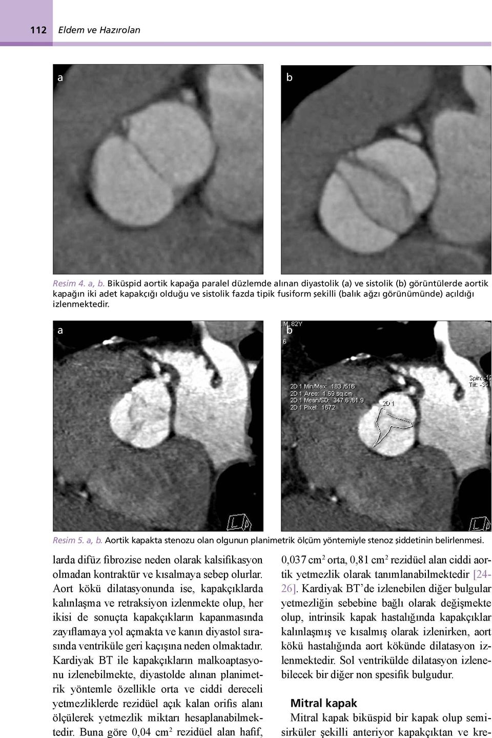 Resim 5.,. Aortik kpkt stenozu oln olgunun plnimetrik ölçüm yöntemiyle stenoz şiddetinin elirlenmesi. lrd difüz firozise neden olrk klsifiksyon olmdn kontrktür ve kıslmy seep olurlr.