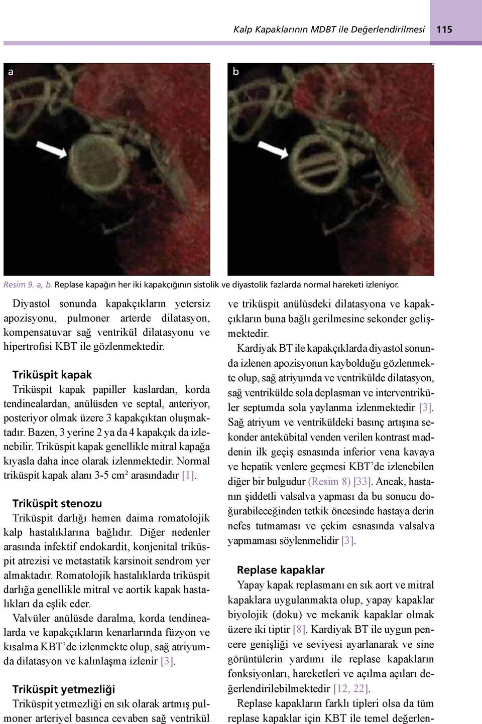 Triküspit kpk Triküspit kpk ppiller kslrdn, kord tendinelrdn, nülüsden ve septl, nteriyor, posteriyor olmk üzere 3 kpkçıktn oluşmktdır. Bzen, 3 yerine 2 y d 4 kpkçık d izleneilir.