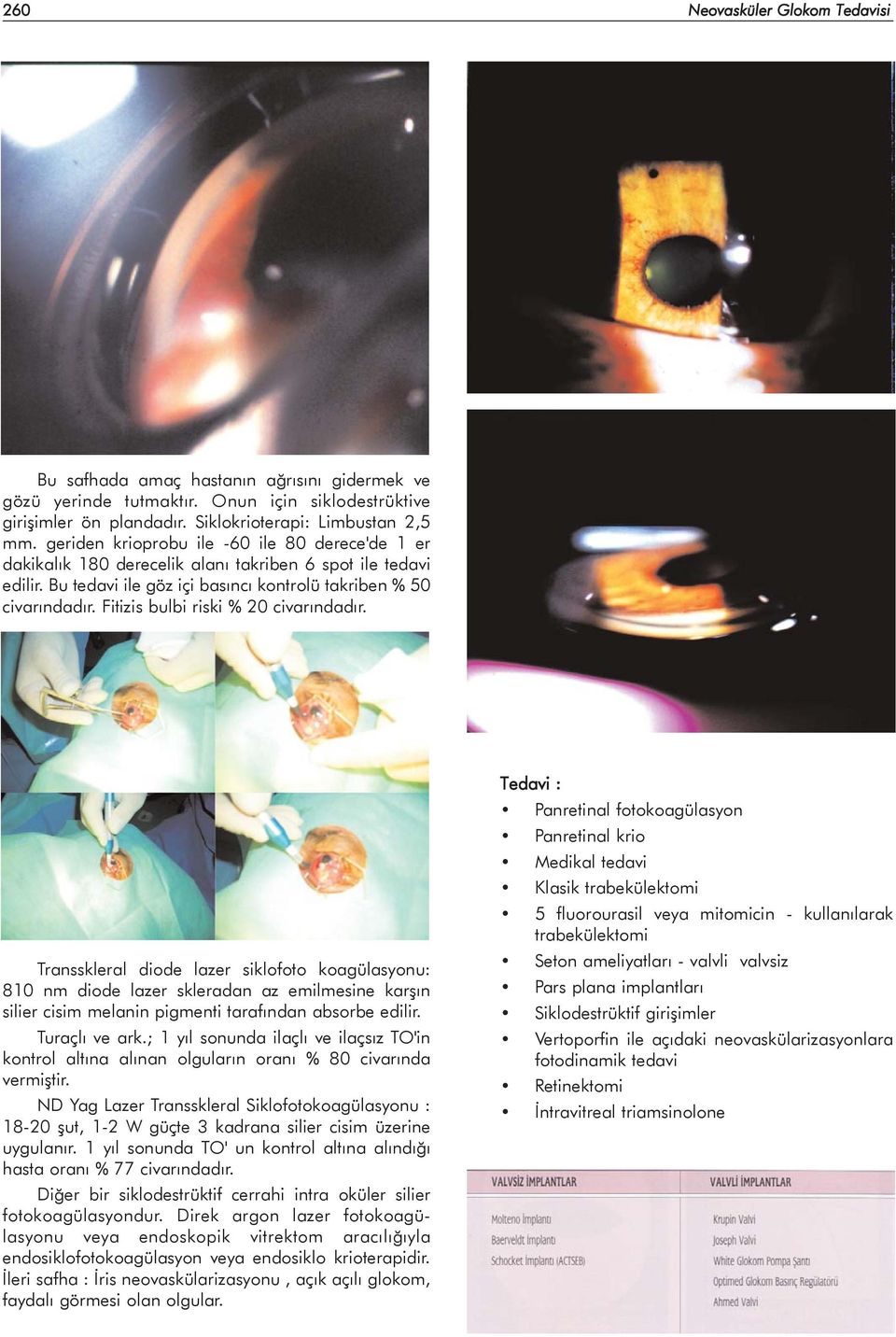 Fitizis bulbi riski % 20 civarýndadýr. Transskleral diode lazer siklofoto koagülasyonu: 810 nm diode lazer skleradan az emilmesine karþýn silier cisim melanin pigmenti tarafýndan absorbe edilir.