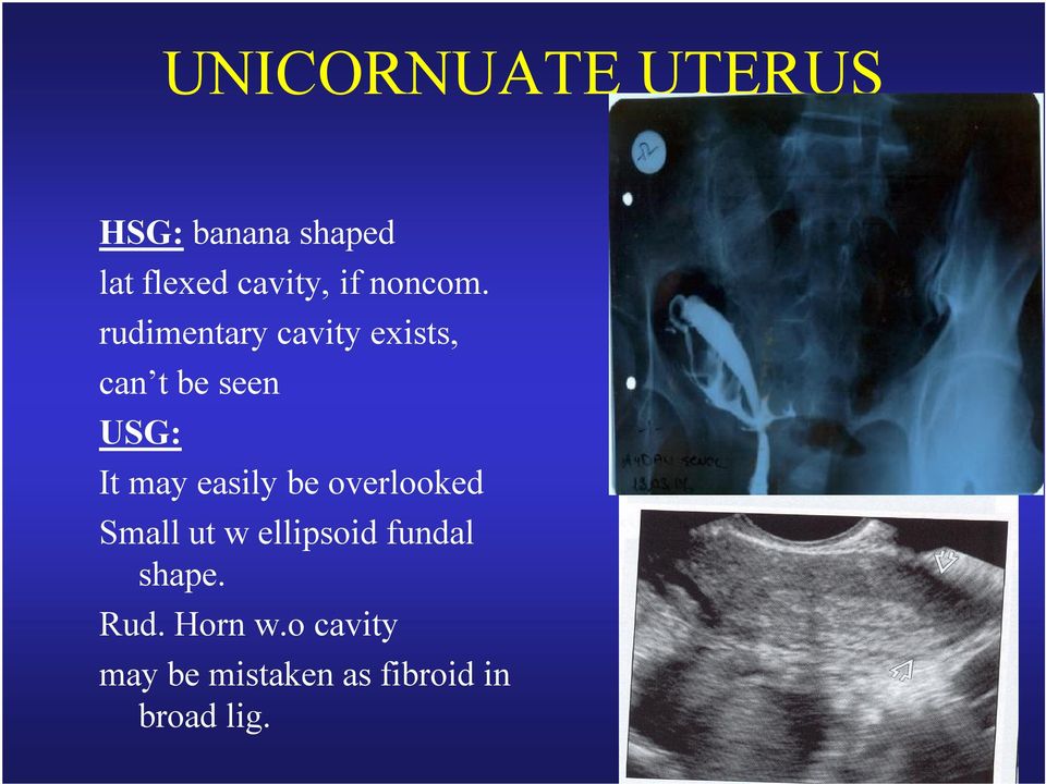 rudimentary cavity exists, can t be seen USG: It may easily