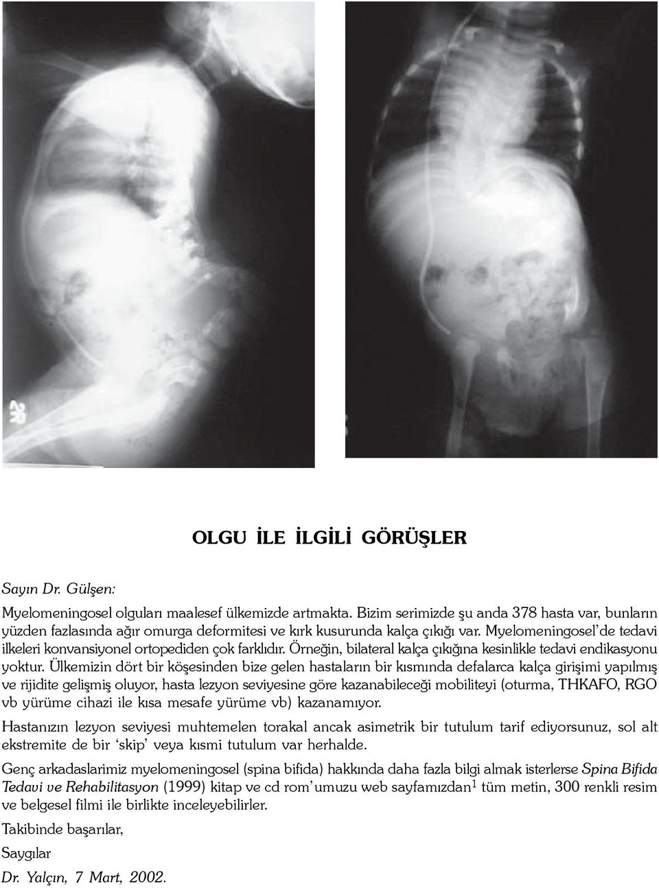 Myelomeningosel de tedavi ilkeleri konvansiyonel ortopediden çok farklýdýr. Örneðin, bilateral kalça çýkýðýna kesinlikle tedavi endikasyonu yoktur.