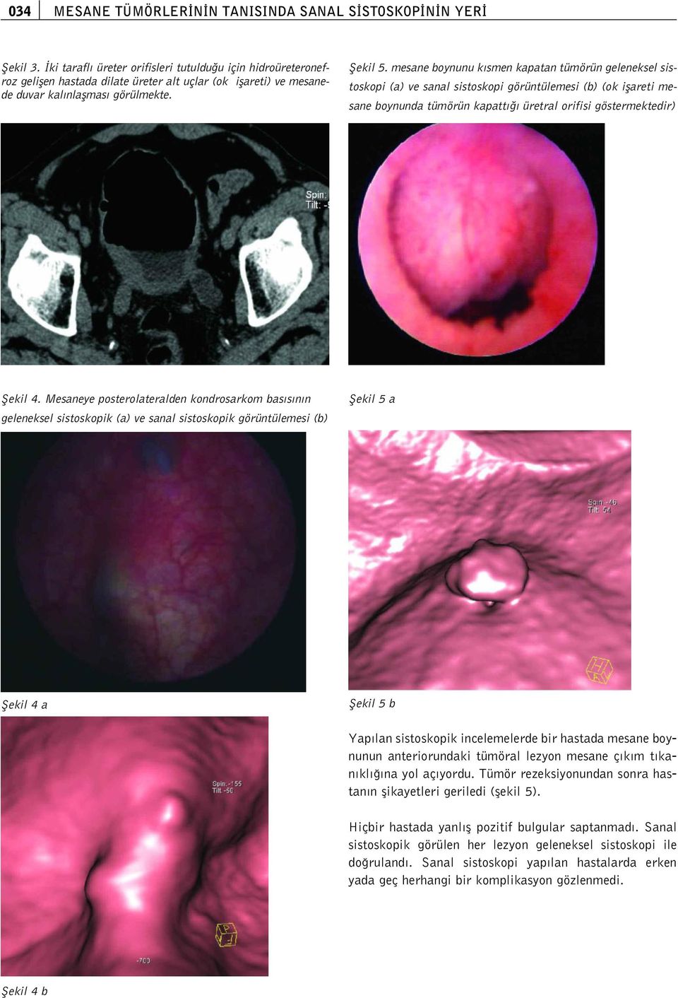 mesane boynunu k smen kapatan tümörün geleneksel sistoskopi (a) ve sanal sistoskopi görüntülemesi (b) (ok iflareti mesane boynunda tümörün kapatt üretral orifisi göstermektedir) fiekil 4.
