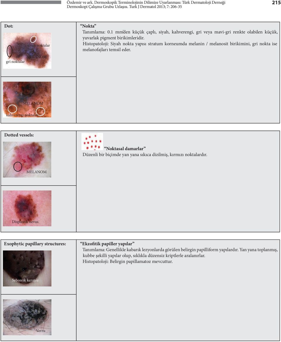 Histopatoloji: Siyah nokta yapısı stratum korneumda melanin / melanosit birikimini, gri nokta ise melanofajları temsil eder.