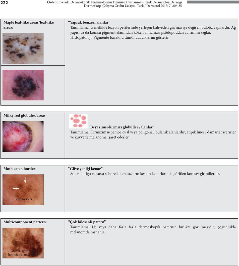 gri/maviye değişen bulböz yapılardır. Ağ yapısı ya da komşu pigment alanından köken almaması psödopoddan ayırımını sağlar. Histopatoloji: Pigmente bazaloid tümör adacıklarını gösterir.