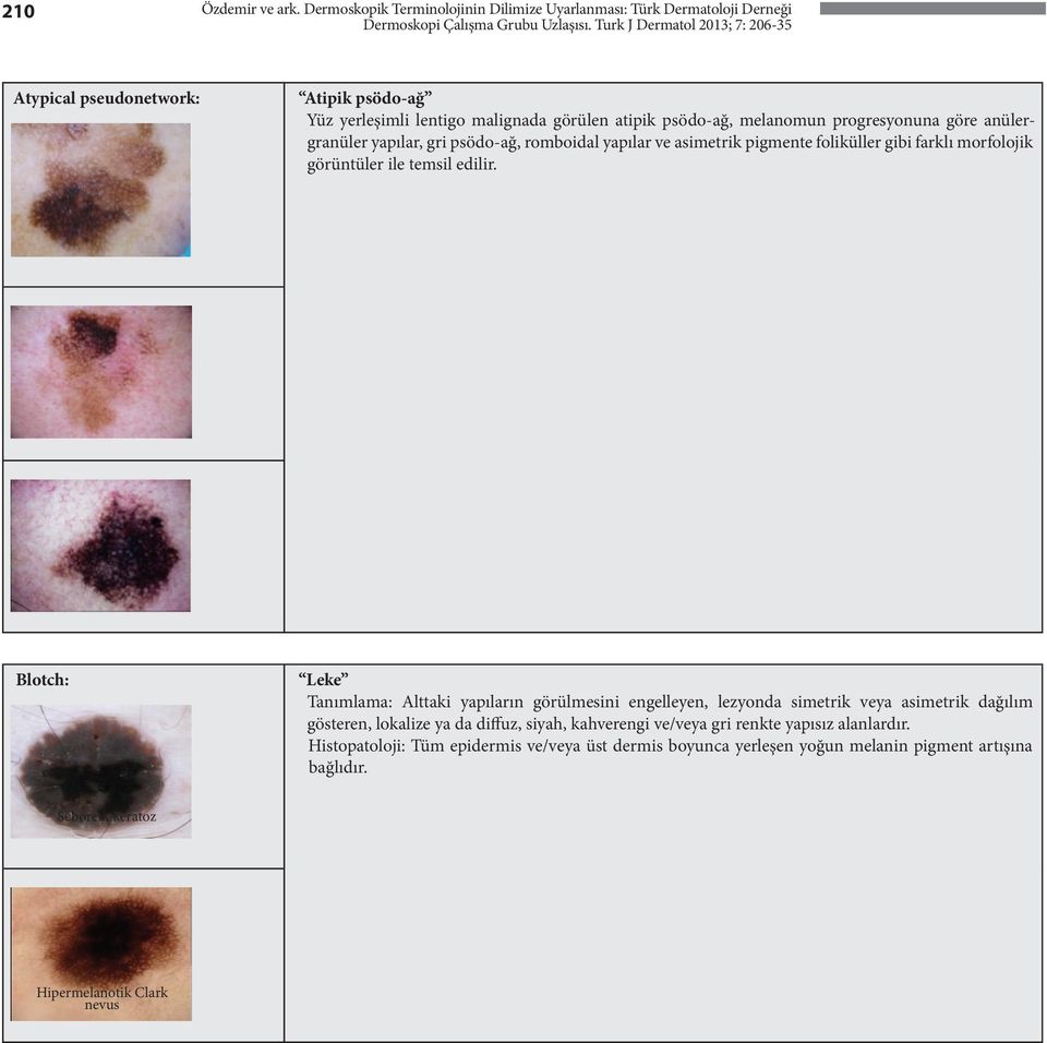 melanomun progresyonuna göre anülergranüler yapılar, gri psödo-ağ, romboidal yapılar ve asimetrik pigmente foliküller gibi farklı morfolojik görüntüler ile temsil edilir.