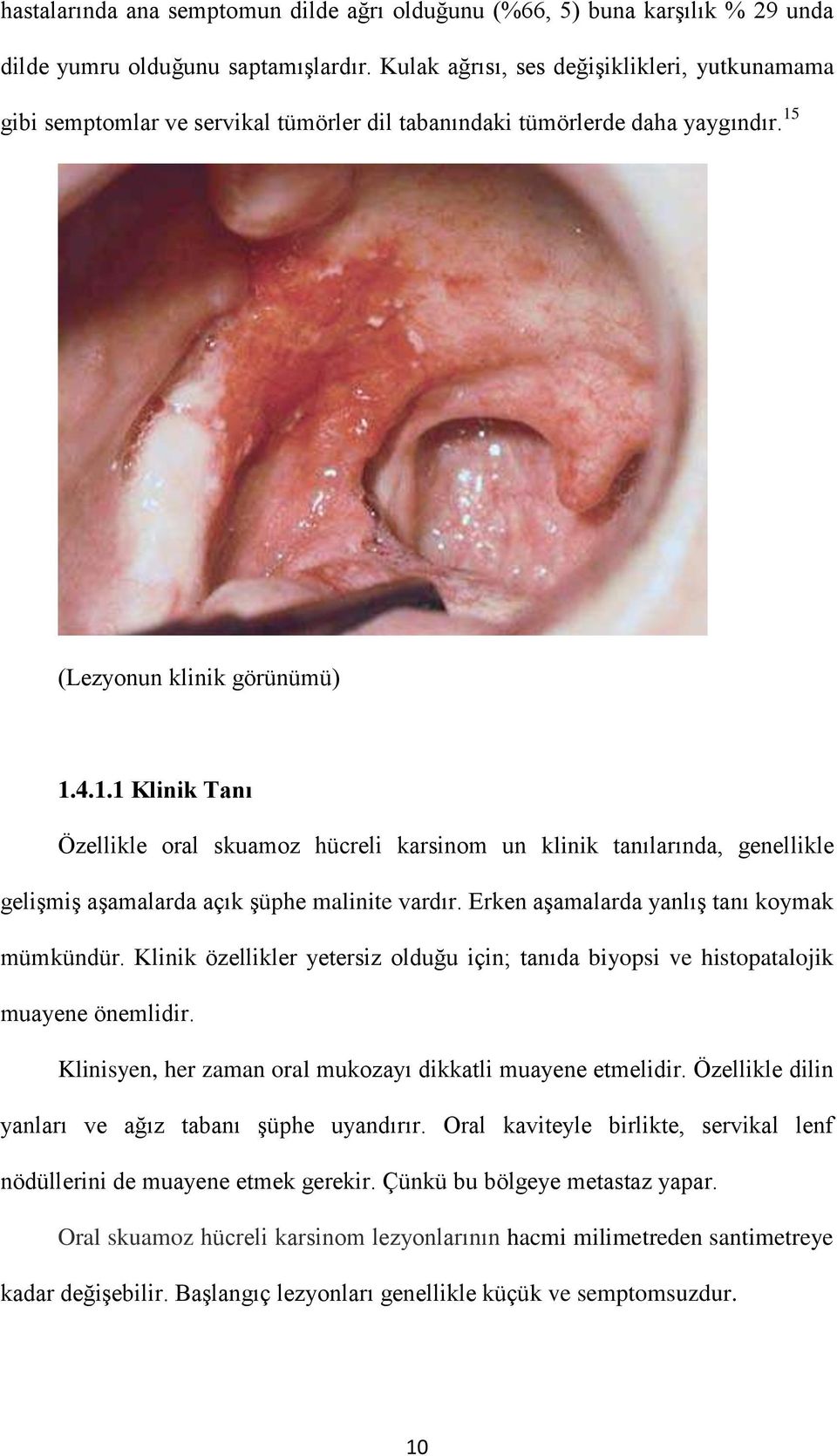 (Lezyonun klinik görünümü) 1.4.1.1 Klinik Tanı Özellikle oral skuamoz hücreli karsinom un klinik tanılarında, genellikle gelişmiş aşamalarda açık şüphe malinite vardır.