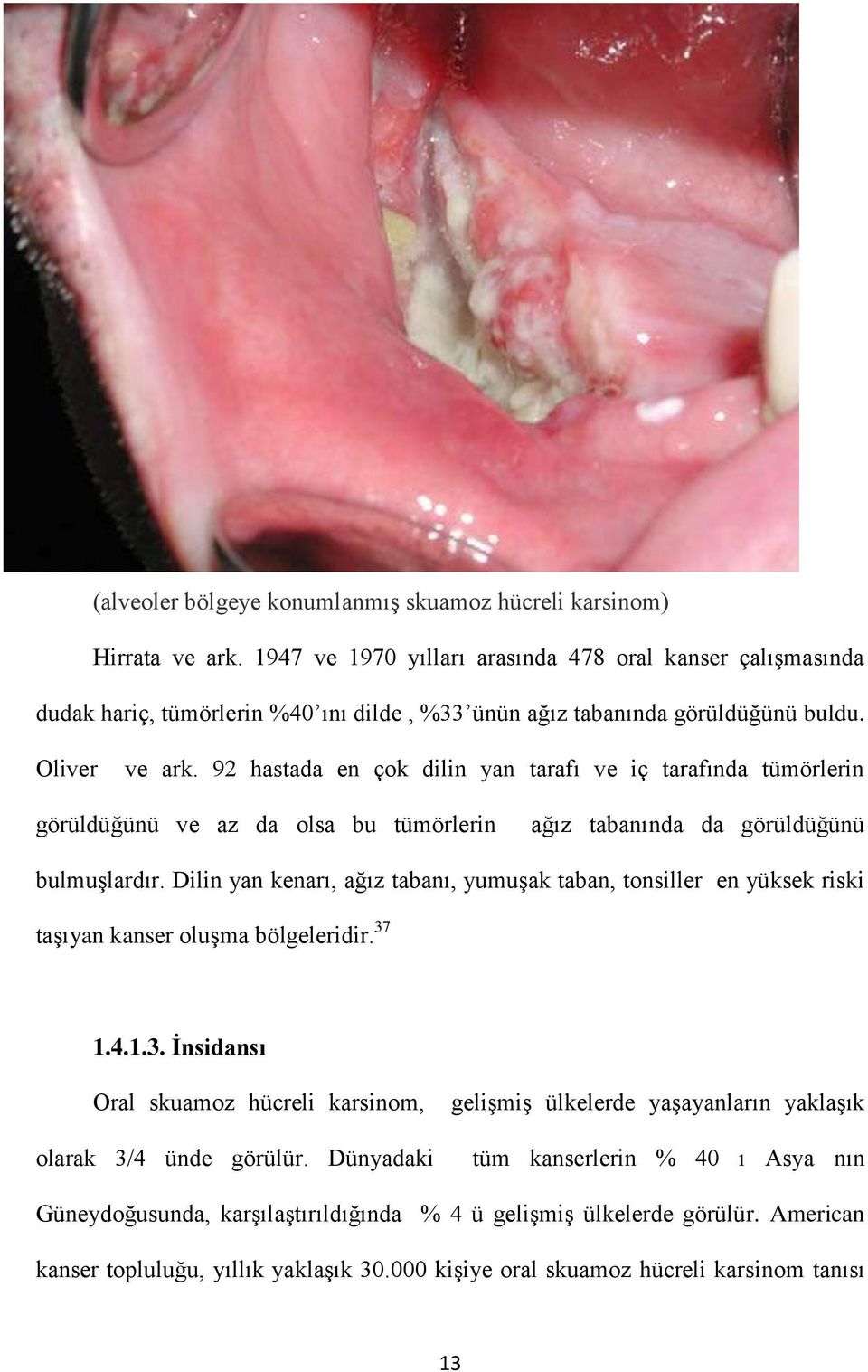 92 hastada en çok dilin yan tarafı ve iç tarafında tümörlerin görüldüğünü ve az da olsa bu tümörlerin ağız tabanında da görüldüğünü bulmuşlardır.