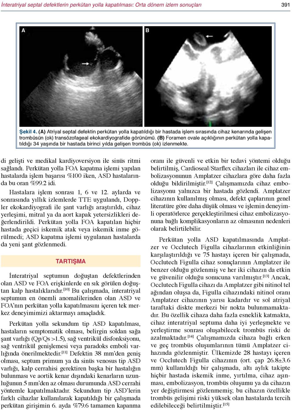 (B) Foramen ovale açıklığının perkütan yolla kapatıldığı 34 yaşında bir hastada birinci yılda gelişen trombüs (ok) izlenmekte. di gelişti ve medikal kardiyoversiyon ile sinüs ritmi sağlandı.