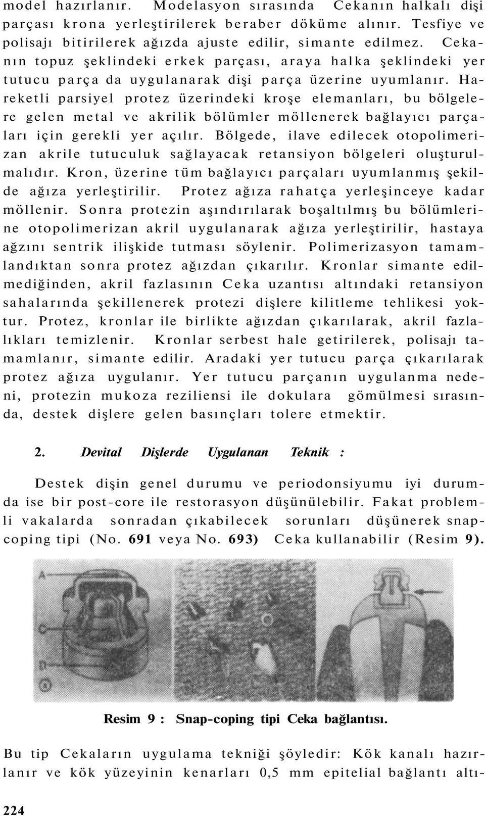 Hareketli parsiyel protez üzerindeki kroşe elemanları, bu bölgelere gelen metal ve akrilik bölümler möllenerek bağlayıcı parçaları için gerekli yer açılır.