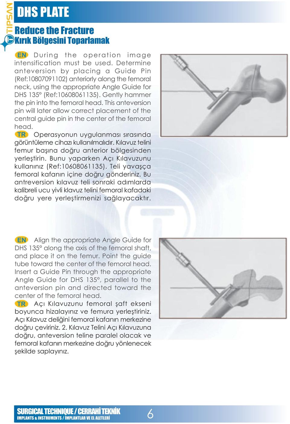 Gently hammer the pin into the femoral head. This anteversion pin will later allow correct placement of the central guide pin in the center of the femoral head.