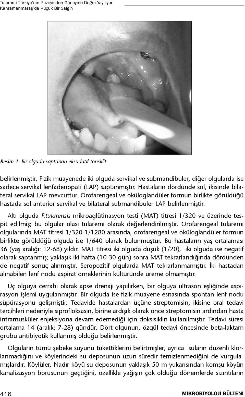 Orofarengeal ve oküloglandüler formun birlikte görüldüğü hastada sol anterior servikal ve bilateral submandibuler LAP belirlenmiştir. Altı olguda F.