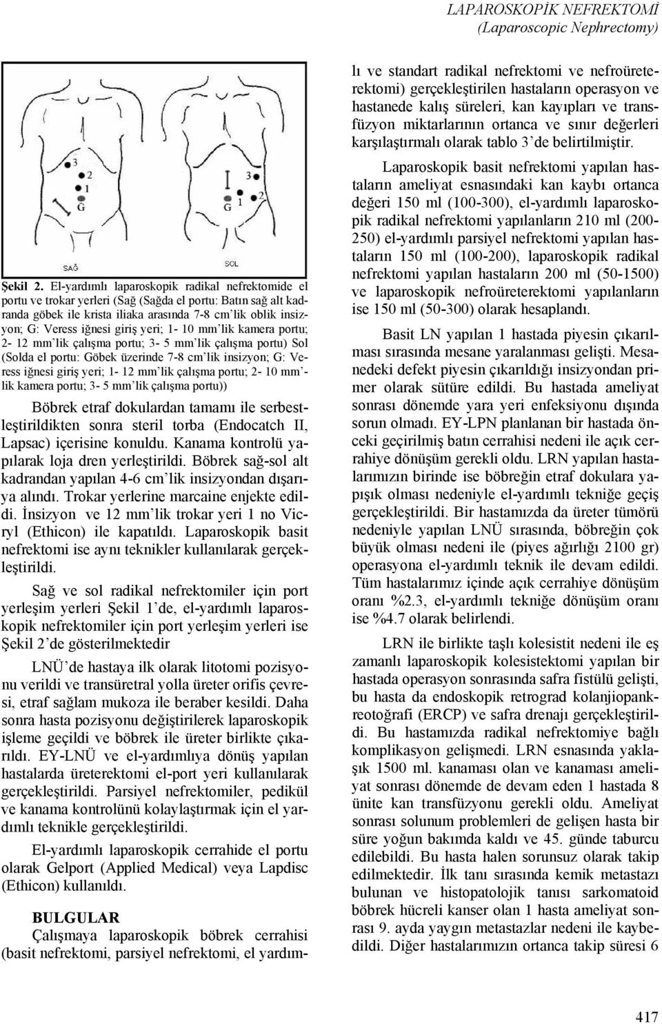 giriş yeri; 1-10 mm lik kamera portu; 2-12 mm lik çalışma portu; 3-5 mm lik çalışma portu) Sol (Solda el portu: Göbek üzerinde 7-8 cm lik insizyon; G: Veress iğnesi giriş yeri; 1-12 mm lik çalışma