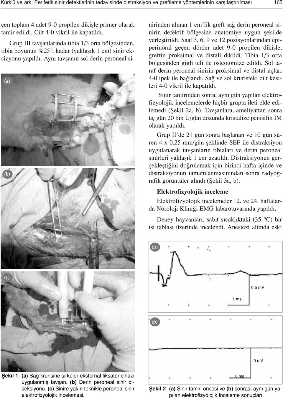 Ayn tavflan n sol derin peroneal sinirinden al nan 1 cm lik greft sa derin peroneal sinirin defektif bölgesine anatomiye uygun flekilde yerlefltirildi.