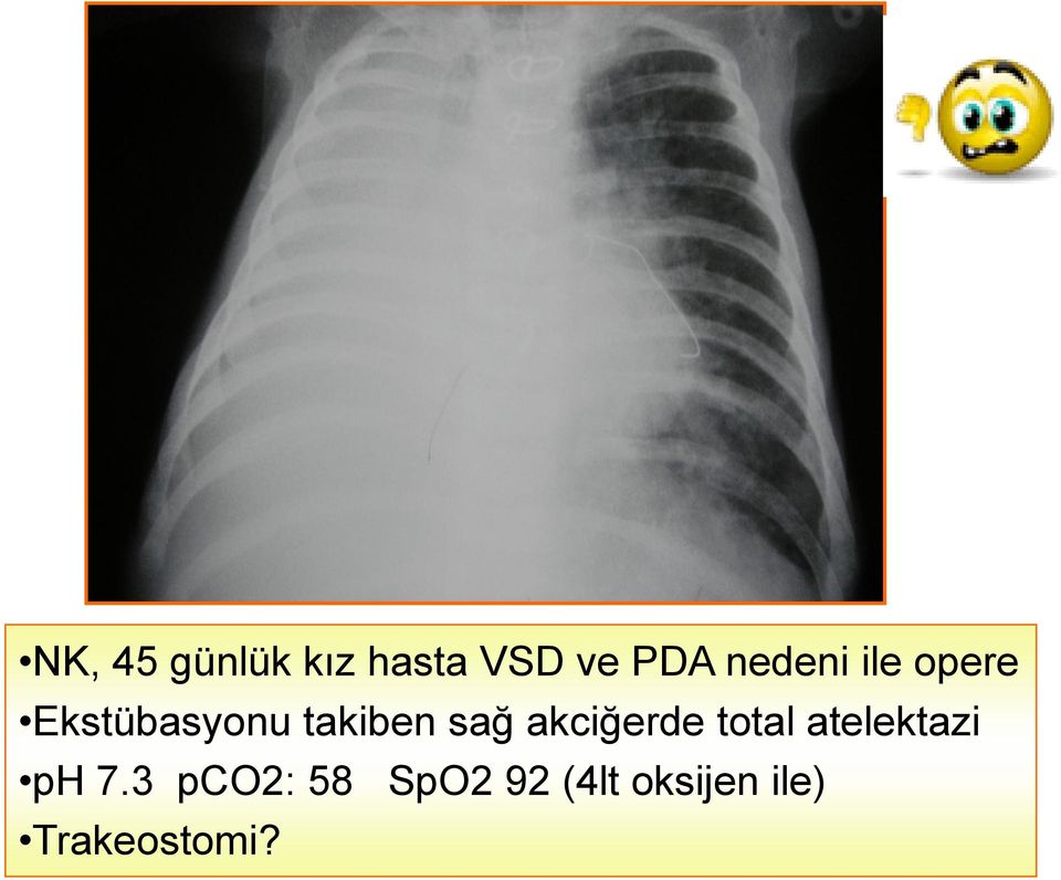 sağ akciğerde total atelektazi ph 7.