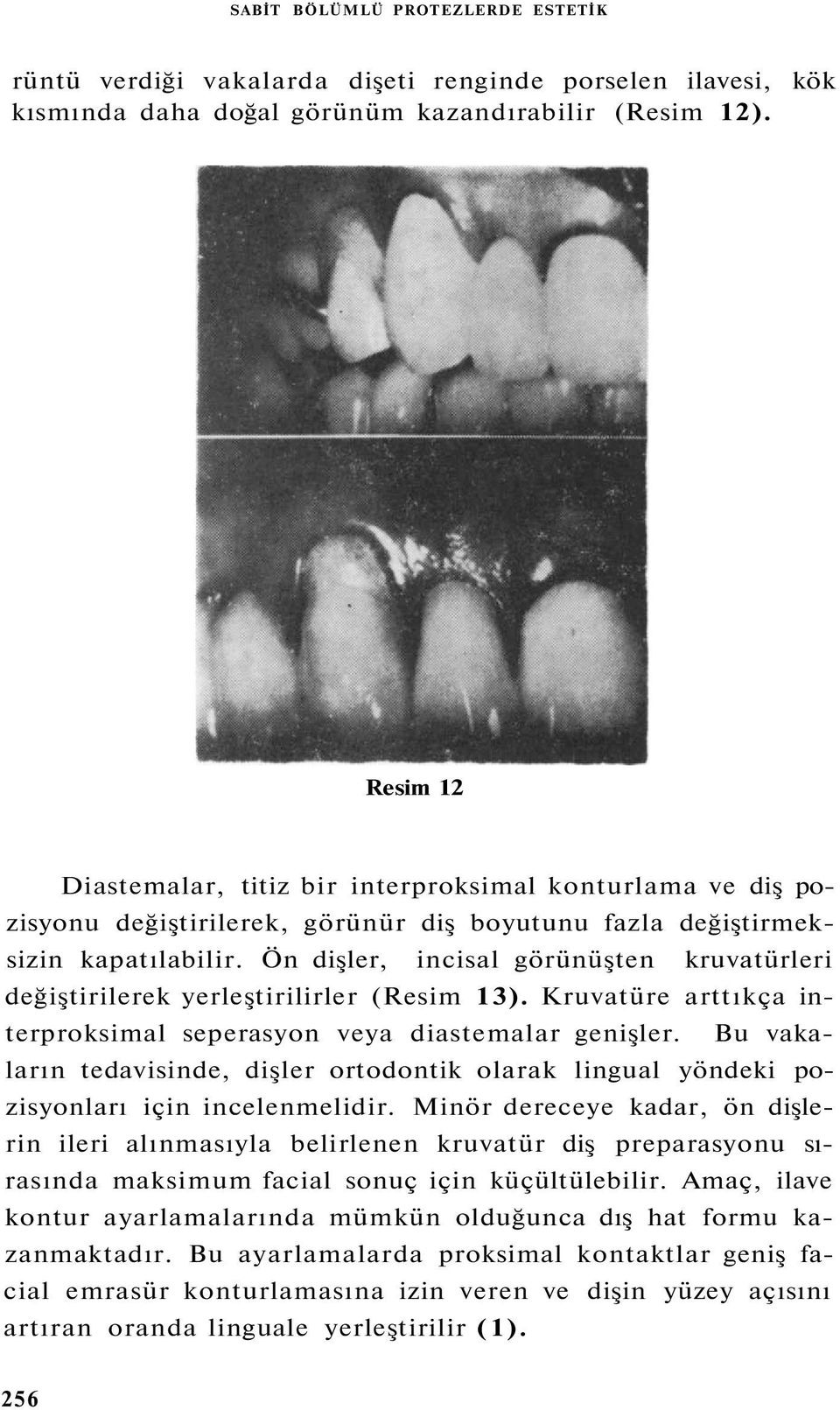 Ön dişler, incisal görünüşten kruvatürleri değiştirilerek yerleştirilirler (Resim 13). Kruvatüre arttıkça interproksimal seperasyon veya diastemalar genişler.