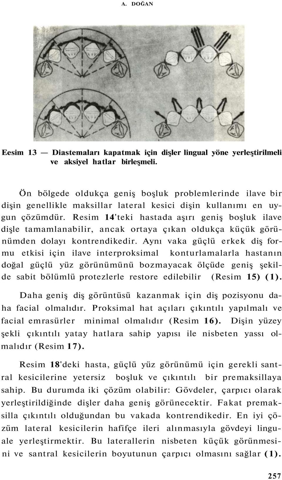 Resim 14'teki hastada aşırı geniş boşluk ilave dişle tamamlanabilir, ancak ortaya çıkan oldukça küçük görünümden dolayı kontrendikedir.