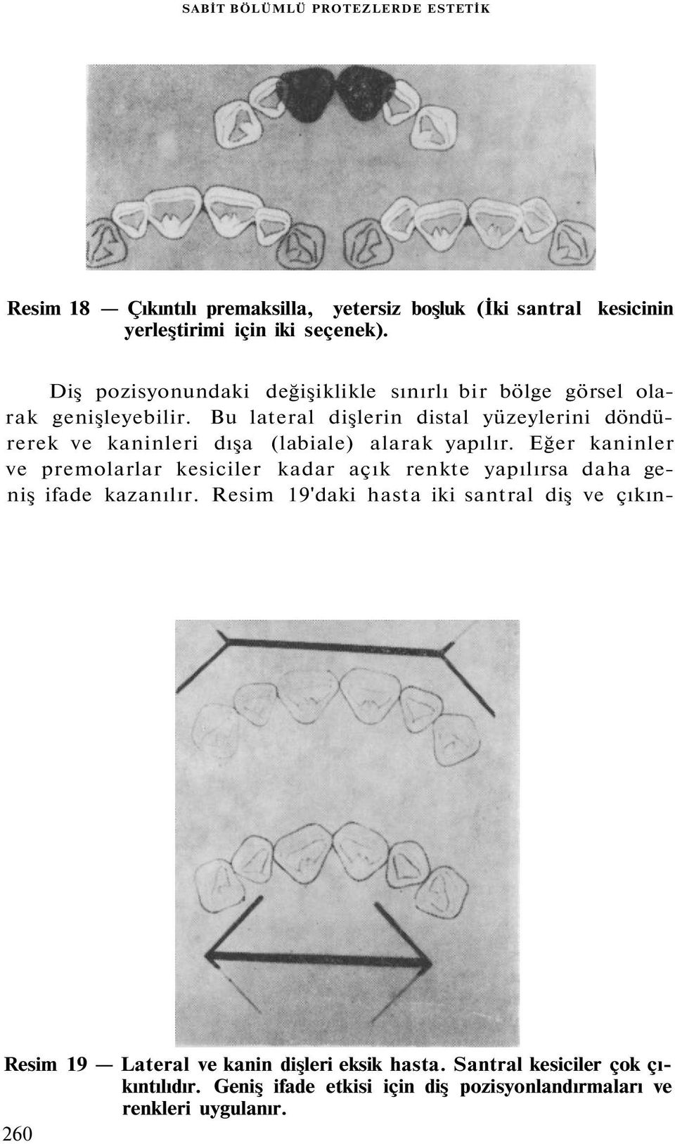 Bu lateral dişlerin distal yüzeylerini döndürerek ve kaninleri dışa (labiale) alarak yapılır.