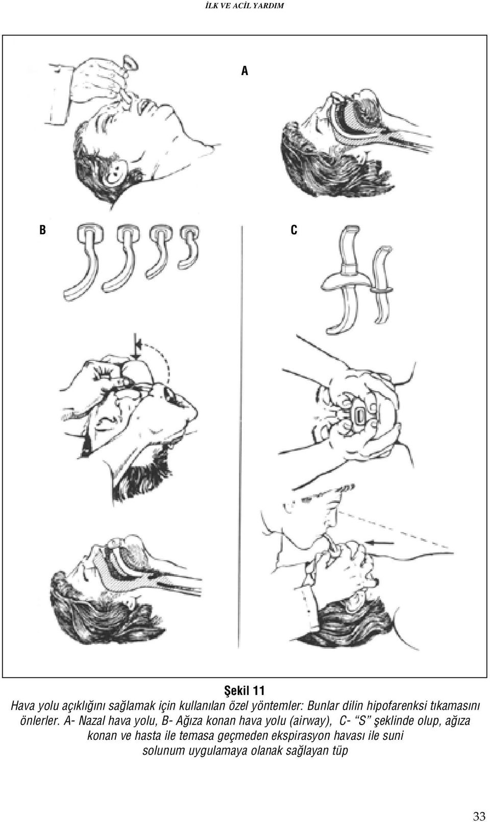 A- Nazal hava yolu, B- A za konan hava yolu (airway), C- S fleklinde olup, a za