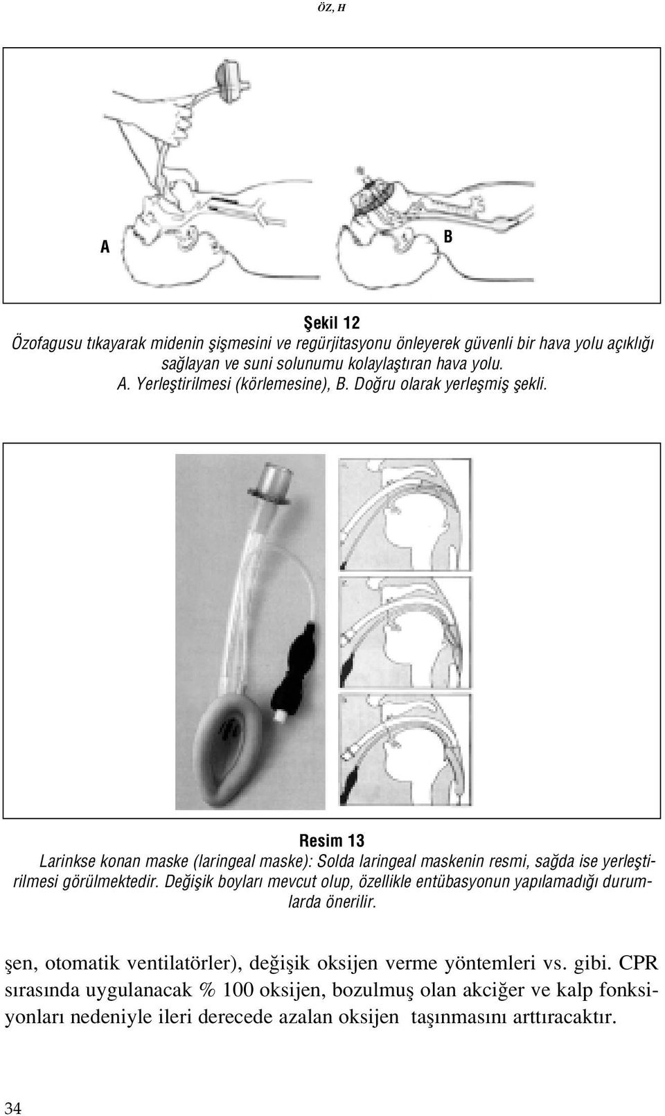 Resim 13 Larinkse konan maske (laringeal maske): Solda laringeal maskenin resmi, sa da ise yerlefltirilmesi görülmektedir.