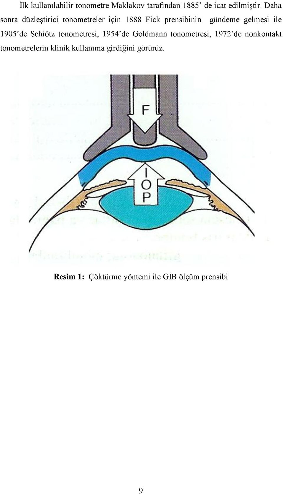 1905 de Schiötz tonometresi, 1954 de Goldmann tonometresi, 1972 de nonkontakt