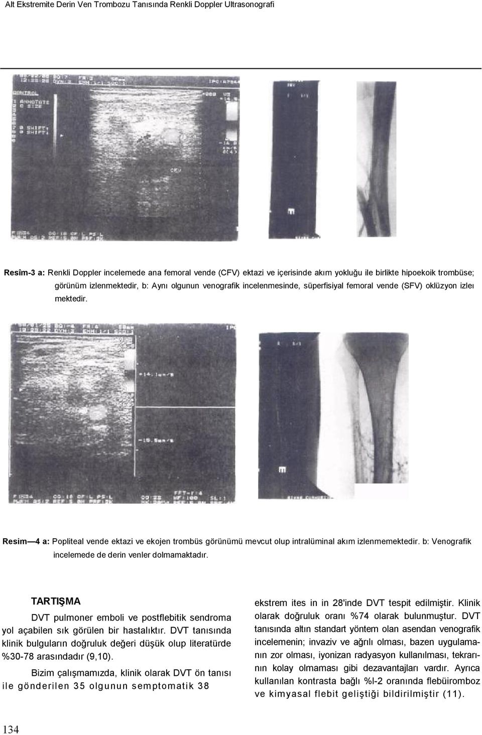 '* Resim 4 a: Popliteal vende ektazi ve ekojen trombüs görünümü mevcut olup intralüminal akım izlenmemektedir. b: Venografik incelemede de derin venler dolmamaktadır.