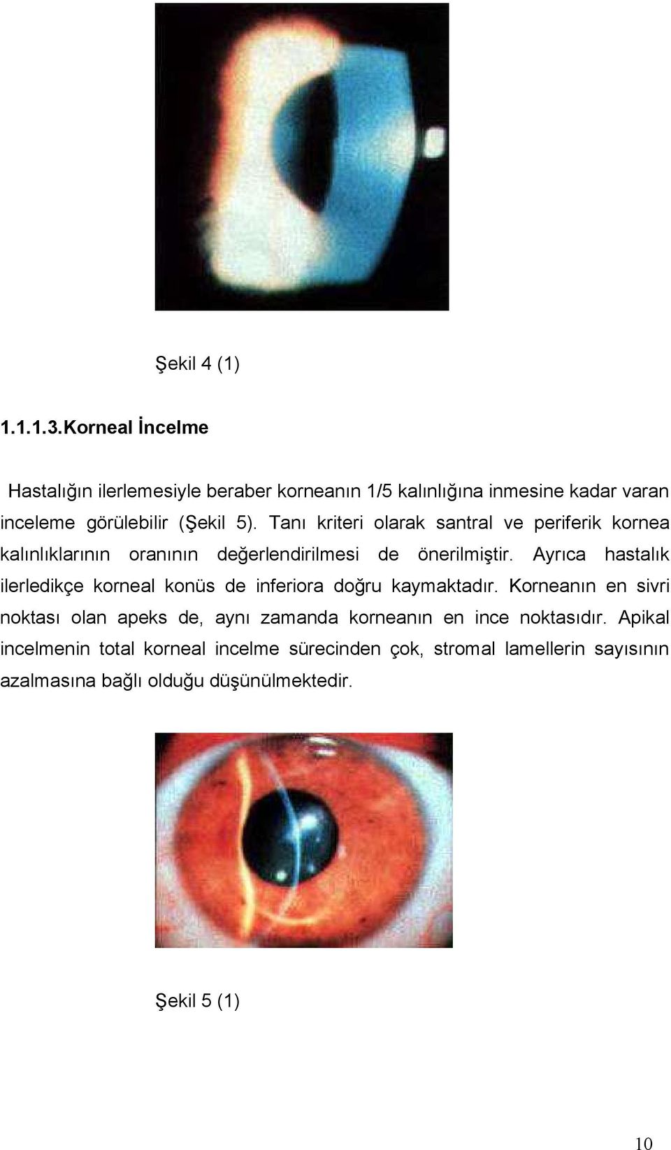 Tanı kriteri olarak santral ve periferik kornea kalınlıklarının oranının değerlendirilmesi de önerilmiştir.