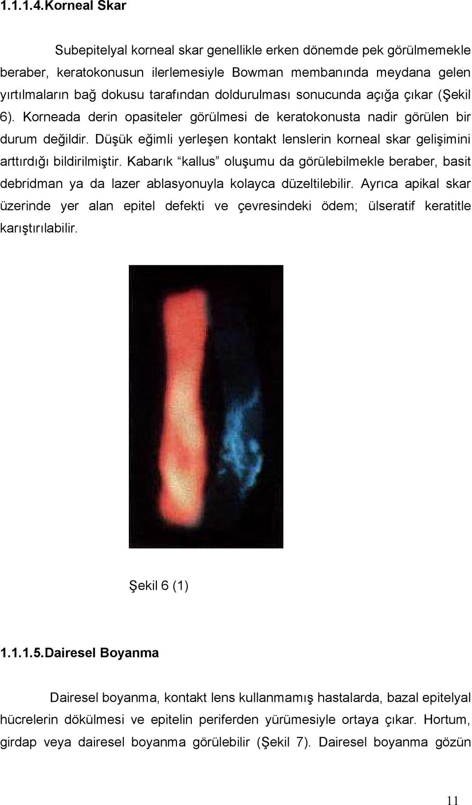 sonucunda açığa çıkar (Şekil 6). Korneada derin opasiteler görülmesi de keratokonusta nadir görülen bir durum değildir.