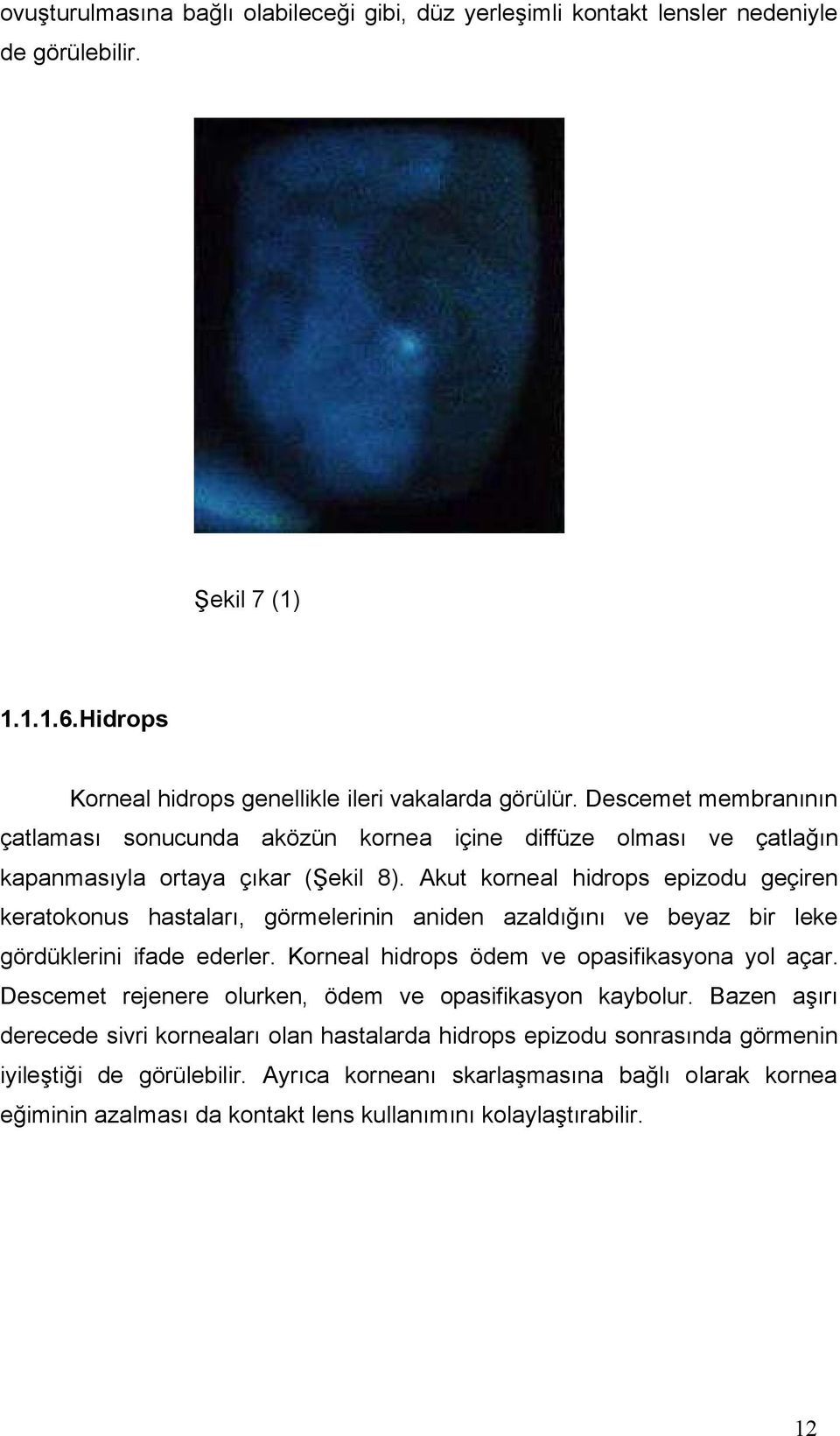 Akut korneal hidrops epizodu geçiren keratokonus hastaları, görmelerinin aniden azaldığını ve beyaz bir leke gördüklerini ifade ederler. Korneal hidrops ödem ve opasifikasyona yol açar.