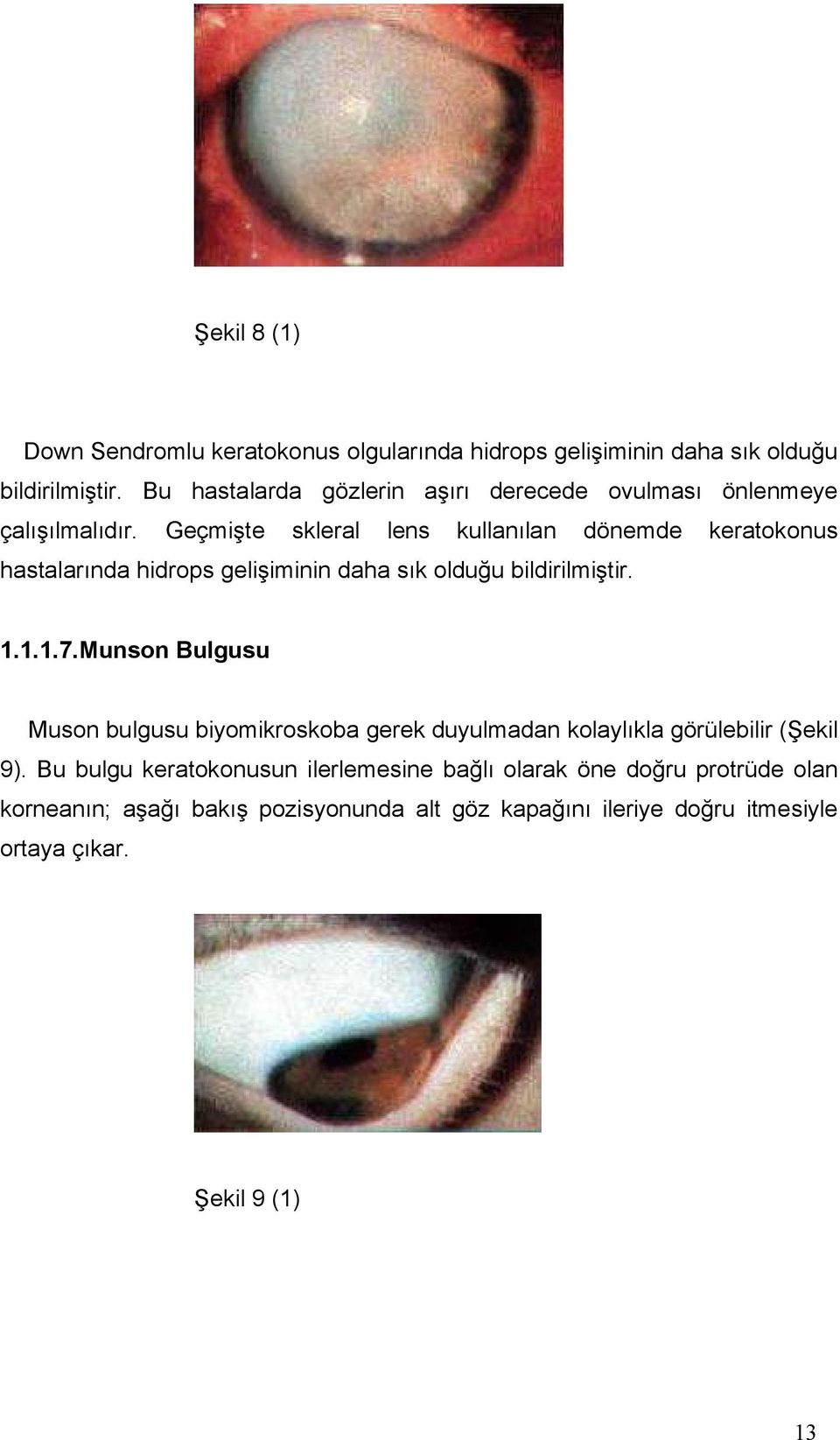 Geçmişte skleral lens kullanılan dönemde keratokonus hastalarında hidrops gelişiminin daha sık olduğu bildirilmiştir. 1.1.1.7.