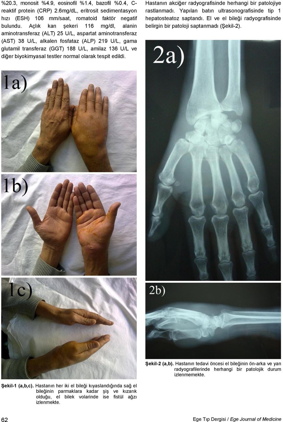 biyokimyasal testler normal olarak tespit edildi. Hastanın akciğer radyografisinde herhangi bir patolojiye rastlanmadı. Yapılan batın ultrasonografisinde tip 1 hepatosteatoz saptandı.