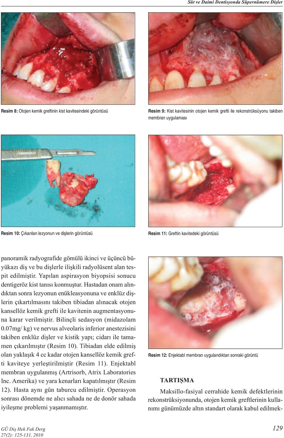 edilmiştir. Yapılan aspirasyon biyopsisi sonucu dentigeröz kist tanısı konmuştur.