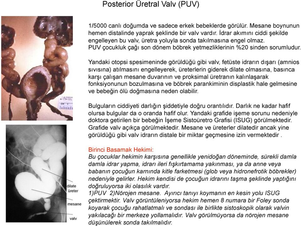 Yandaki otopsi spesimeninde görüldüğü gibi valv, fetüste idrarın dışarı (amnios sıvısına) atılmasını engelleyerek, üreterlerin giderek dilate olmasına, basınca karşı çalışan mesane duvarının ve