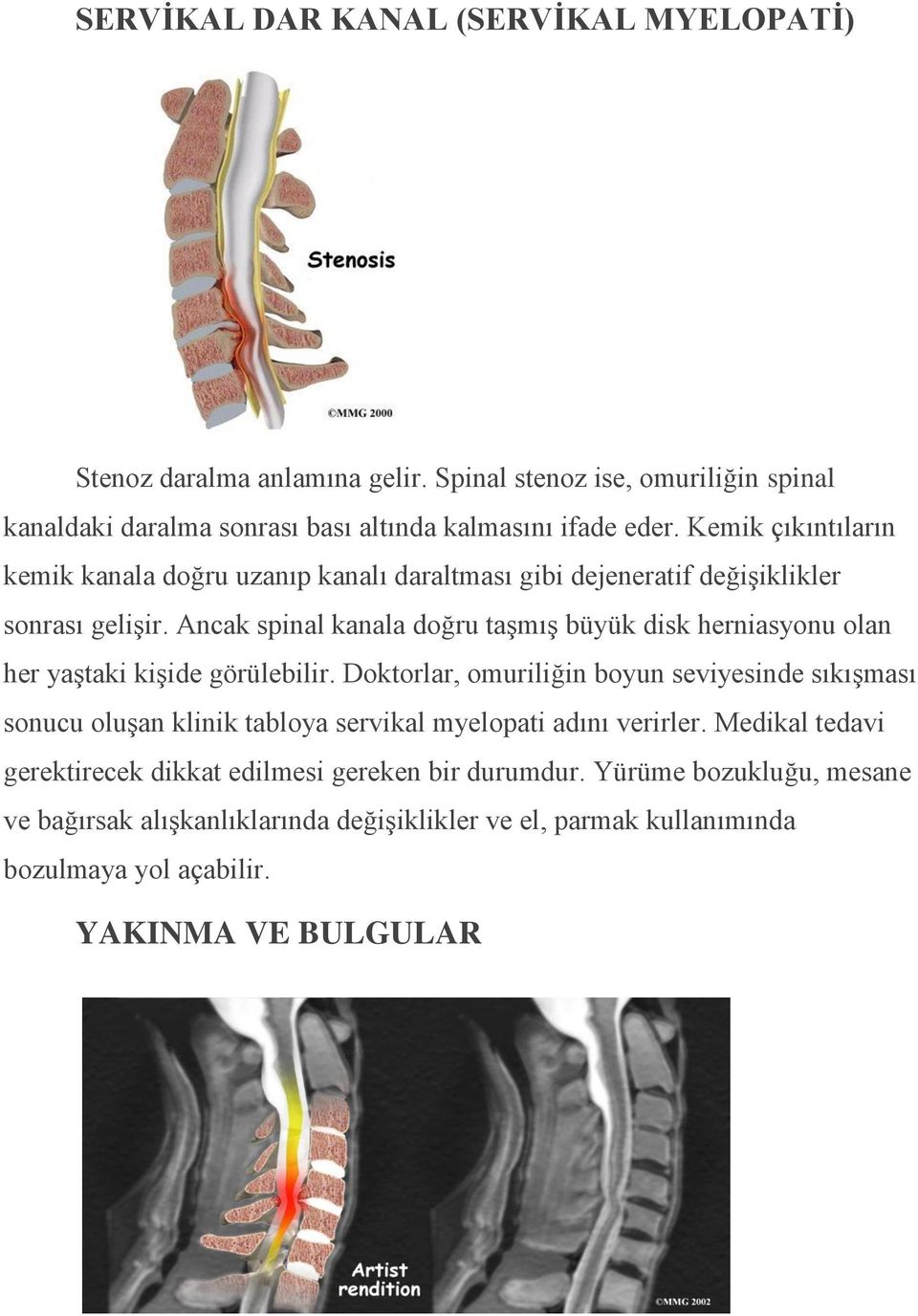 Ancak spinal kanala doğru taşmış büyük disk herniasyonu olan her yaştaki kişide görülebilir.