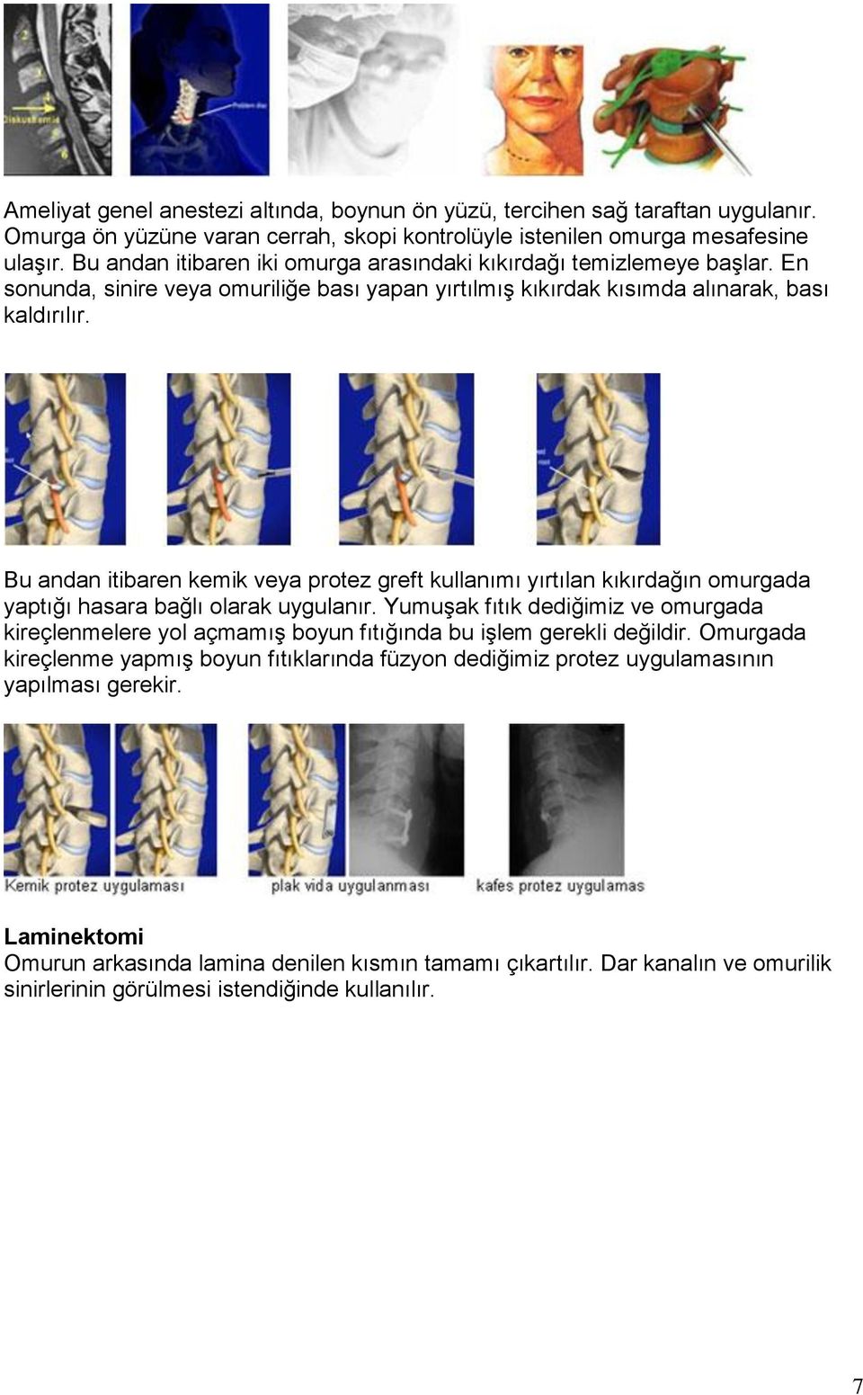 Bu andan itibaren kemik veya protez greft kullanımı yırtılan kıkırdağın omurgada yaptığı hasara bağlı olarak uygulanır.