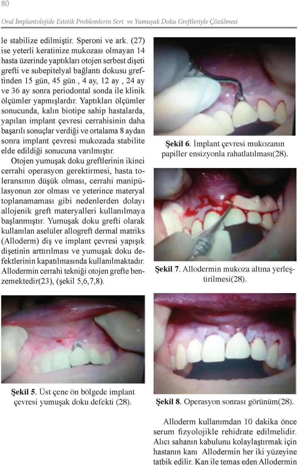 periodontal sonda ile klinik ölçümler yapmışlardır.