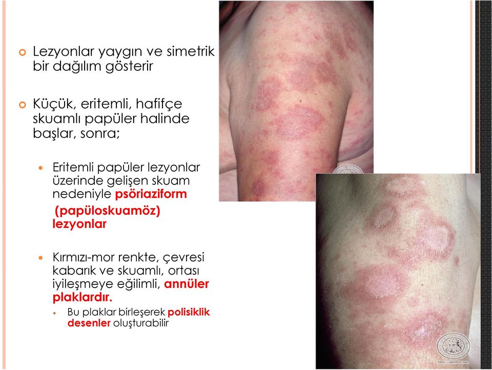 psöriaziform (papüloskuamöz) lezyonlar Kırmızı-mor renkte, çevresi kabarık ve skuamlı,