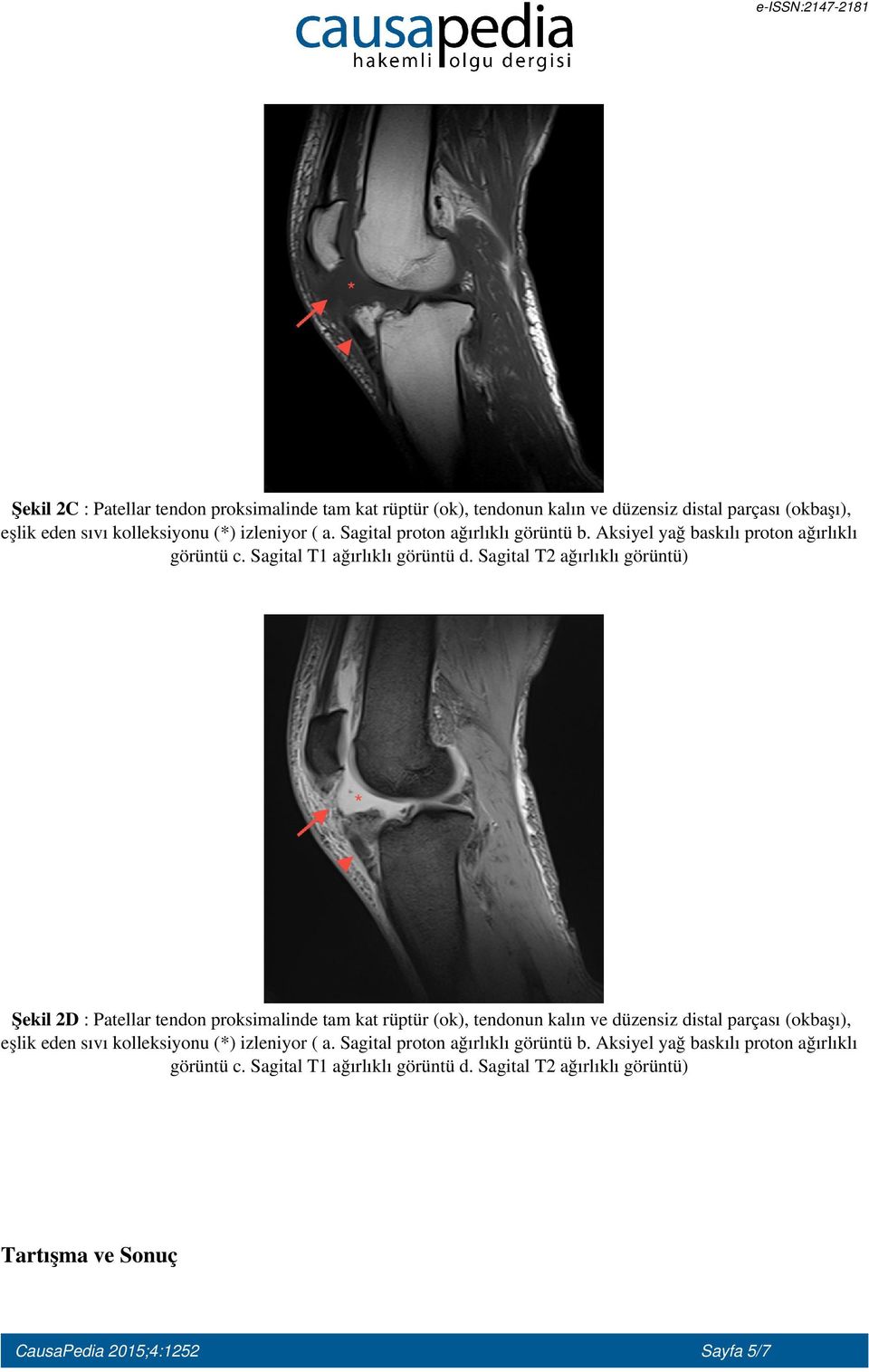 Patellar tendon proksimalinde tam kat rüptür (ok), tendonun kalın ve