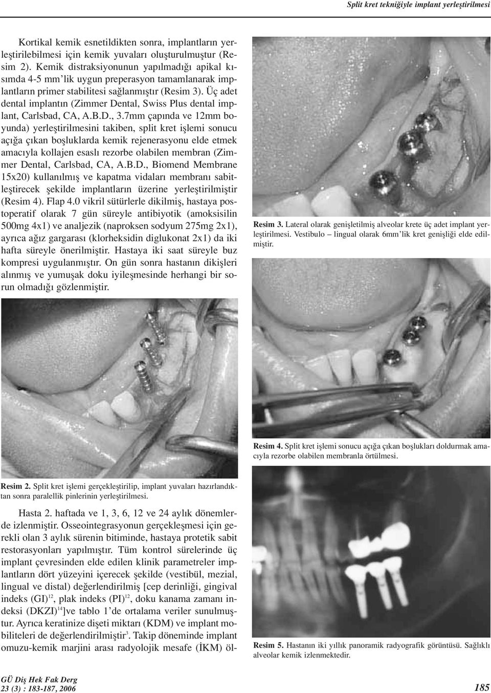 Üç adet dental implant n (Zimmer Dental, Swiss Plus dental implant, Carlsbad, CA, A.B.D., 3.