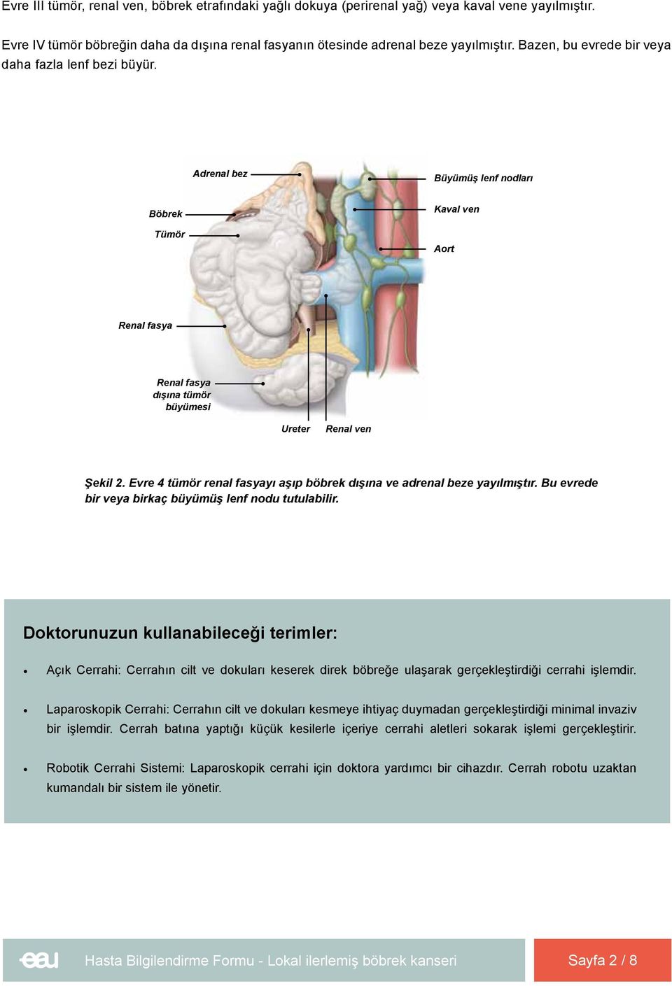 Evre 4 tümör renal fasyayı aşıp böbrek dışına ve adrenal beze yayılmıştır. Bu evrede bir veya birkaç büyümüş lenf nodu tutulabilir.