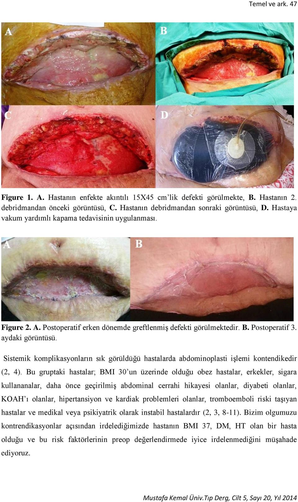 Sistemik komplikasyonların sık görüldüğü hastalarda abdominoplasti işlemi kontendikedir (2, 4).