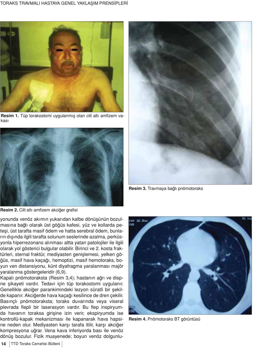 bunların dışında ilgili tarafta solunum seslerinde azalma, perküsyonla hiperrezonans alınması altta yatan patolojiler ile ilgili olarak yol gösterici bulgular olabilir. Birinci ve 2.