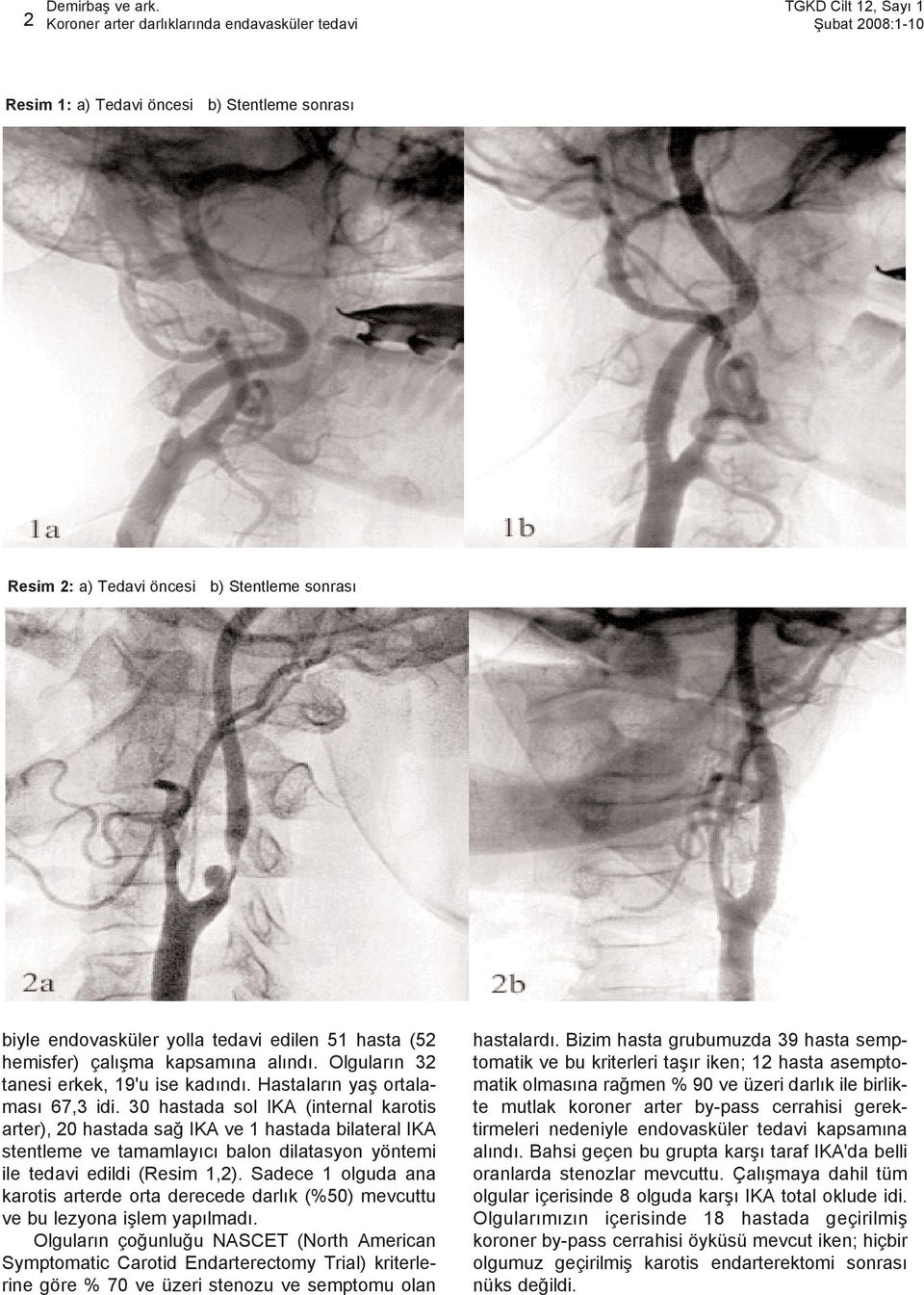 30 hastada sol IKA (internal karotis arter), 20 hastada sað IKA ve 1 hastada bilateral IKA stentleme ve tamamlayýcý balon dilatasyon yöntemi ile tedavi edildi (Resim 1,2).