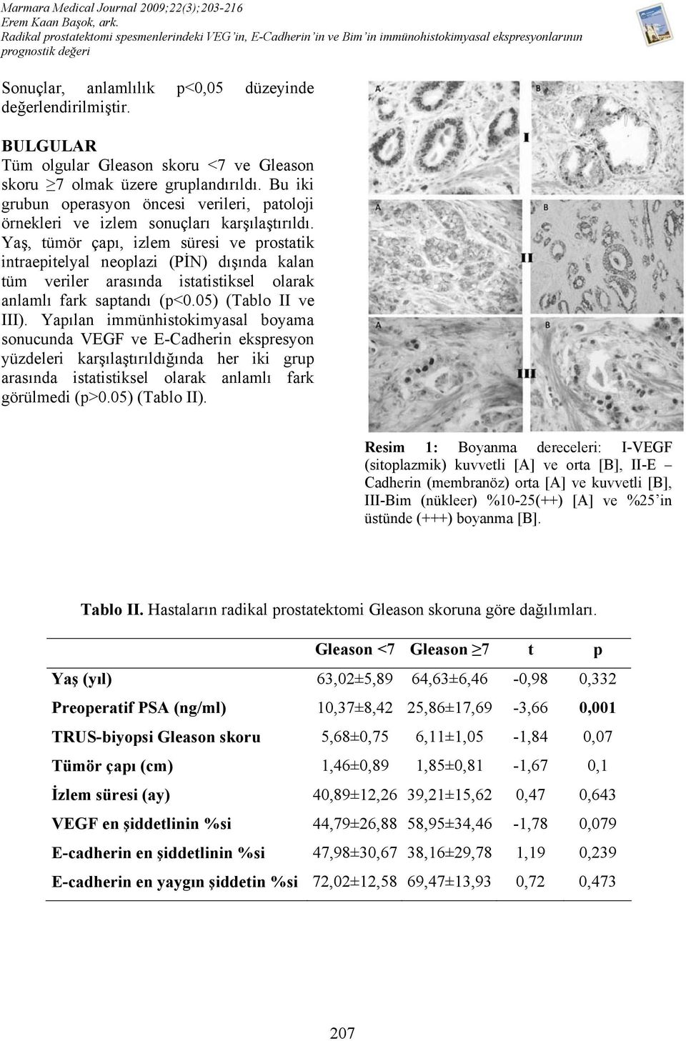 Yaş, tümör çapı, izlem süresi ve prostatik intraepitelyal neoplazi (PİN) dışında kalan tüm veriler arasında istatistiksel olarak anlamlı fark saptandı (p<0.05) (Tablo II ve III).