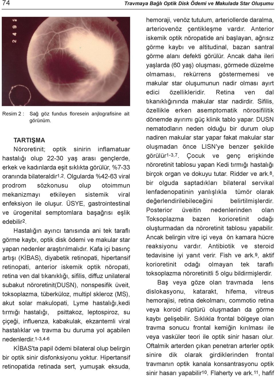 Olgularda %42-63 viral prodrom sözkonusu olup otoimmun mekanizmayý etkileyen sistemik viral enfeksiyon ile oluþur. ÜSYE, gastrointestinal ve ürogenital semptomlara baþaðrýsý eþlik edebilir2.