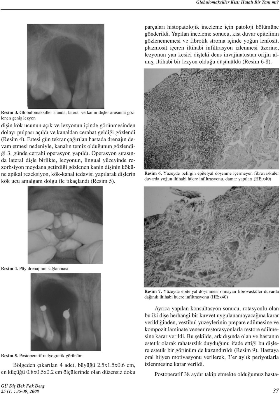 invajinatustan orijin alm fl, iltihabi bir lezyon oldu u düflünüldü (Resim 6-8). Resim 3.
