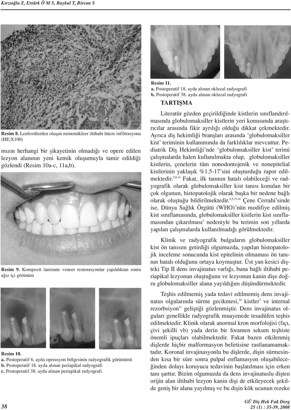 10a-c, 11a,b). Resim 9. Kompozit laminate veneer restorasyonlar yap ld ktan sonra a z içi görünüm Resim 10. a. Postoperatif 6. ayda operasyon bölgesinin radyografik görünümü b. Postoperatif 18.