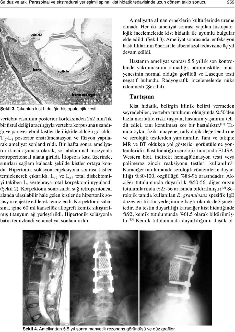 T 12 -L 4 posterior enstrümentasyon ve füzyon yapılarak ameliyat sonlandırıldı. Bir hafta sonra ameliyatın ikinci aşaması olarak, sol abdominal insizyonla retroperitoneal alana girildi.