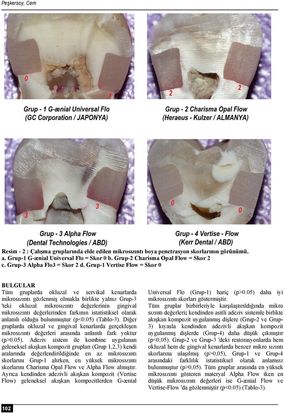 Grup-1 Vertise Flow = Skor 0 BULGULAR Tüm gruplarda okluzal ve servikal kenarlarda mikrosızıntı gözlenmiş olmakla birlikte yalnız Grup-3 'teki okluzal mikrosızıntı değerlerinin gingival mikrosızıntı