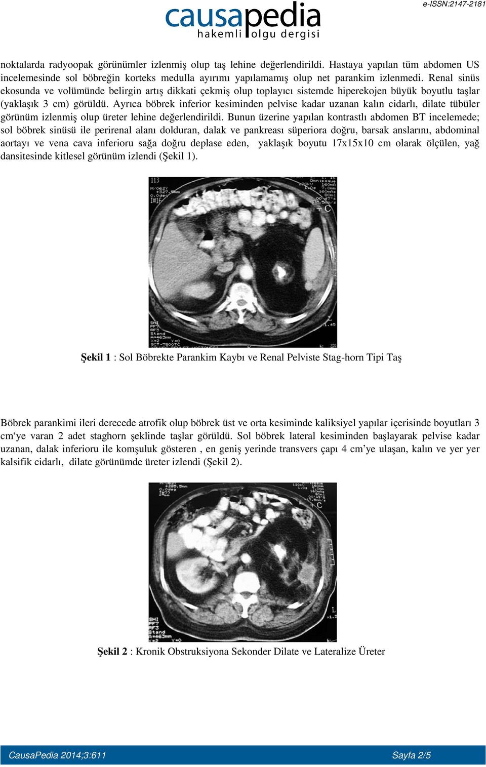 Ayrıca böbrek inferior kesiminden pelvise kadar uzanan kalın cidarlı, dilate tübüler görünüm izlenmiş olup üreter lehine değerlendirildi.